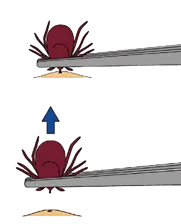 tickremoval.png